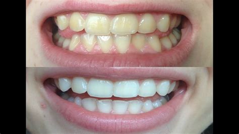 Magic white teeth whiening